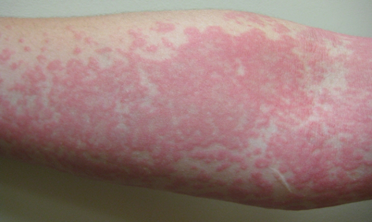 1 de Octubre: Día Mundial de la Urticaria Crónica