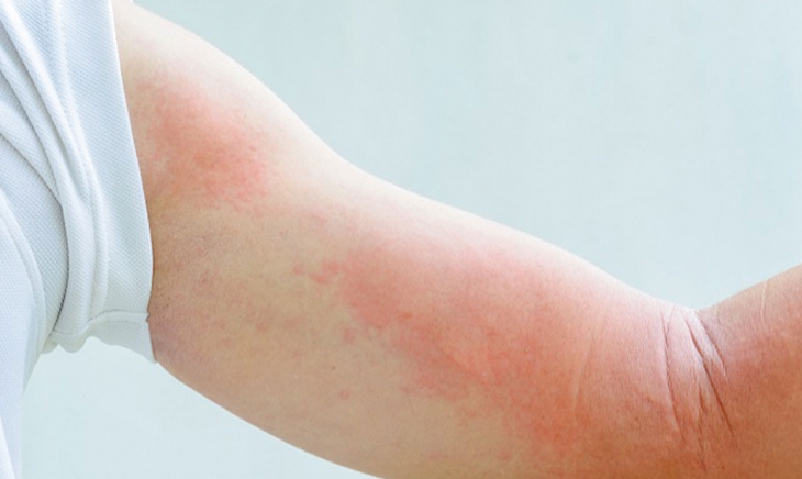 Urticaria, Dermatitis por contacto y Dermatitis Atópica en tiempos de COVID-19